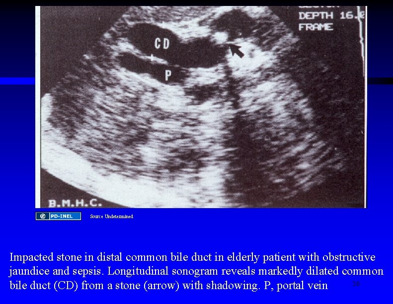 Source Undetermined Impacted stone in distal common bile duct in elderly patient with obstructive