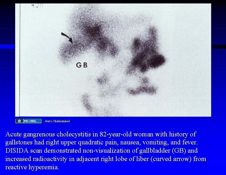 Source Undetermined Acute gangrenous cholecystitis in 82 -year-old woman with history of gallstones had