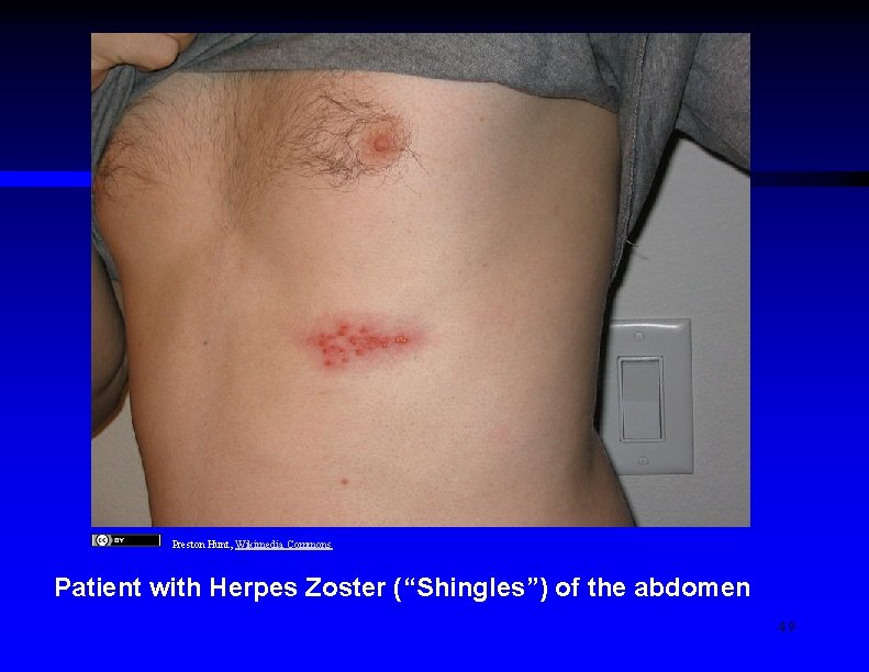 Preston Hunt, Wikimedia Commons Patient with Herpes Zoster (“Shingles”) of the abdomen 49 