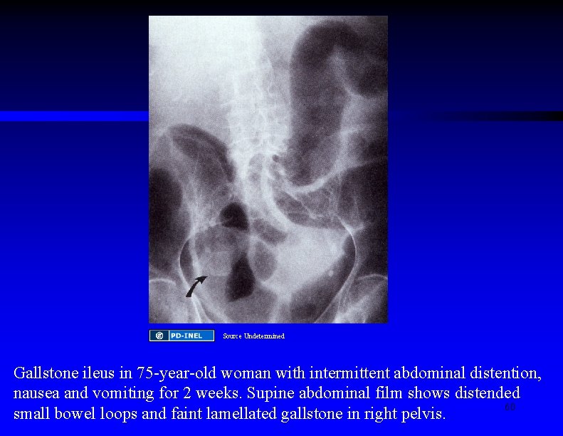 Source Undetermined Gallstone ileus in 75 -year-old woman with intermittent abdominal distention, nausea and
