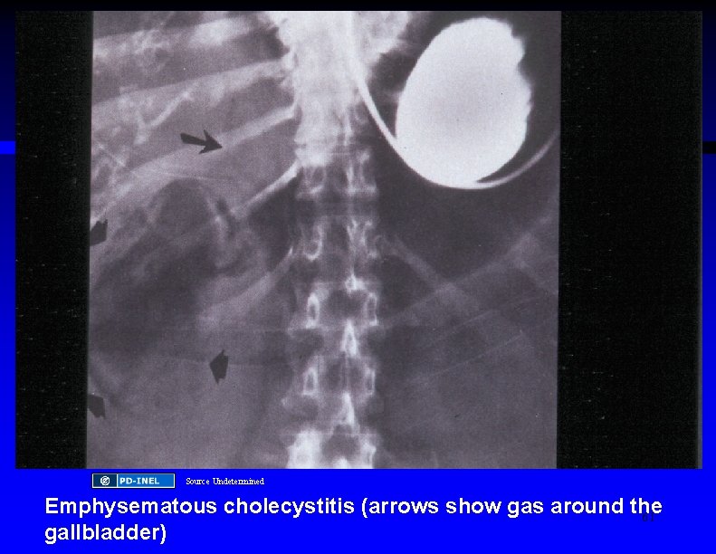 Source Undetermined Emphysematous cholecystitis (arrows show gas around the 61 gallbladder) 