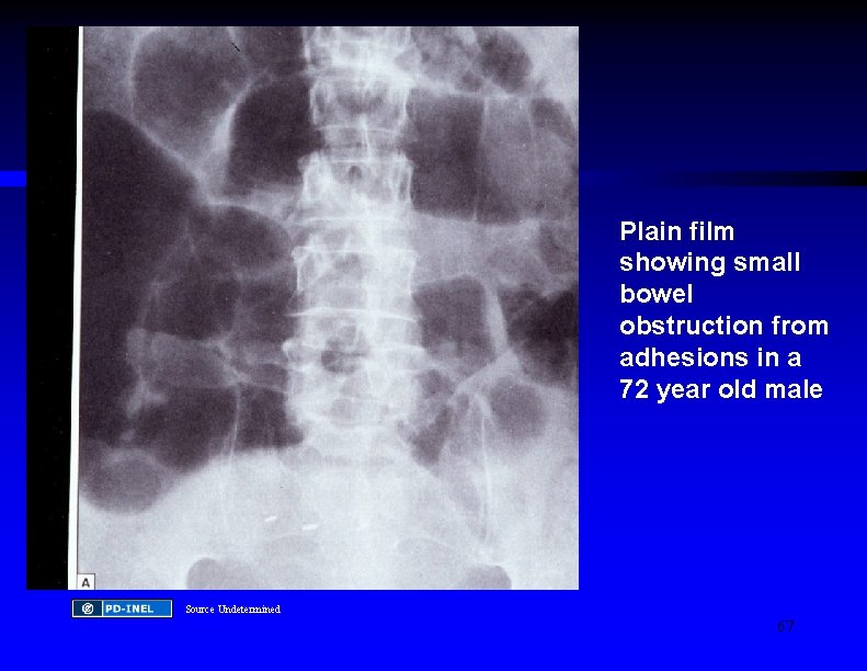 Plain film showing small bowel obstruction from adhesions in a 72 year old male