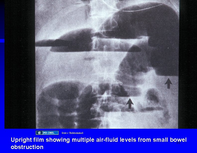 Source Undetermined Upright film showing multiple air-fluid levels from small bowel 68 obstruction 