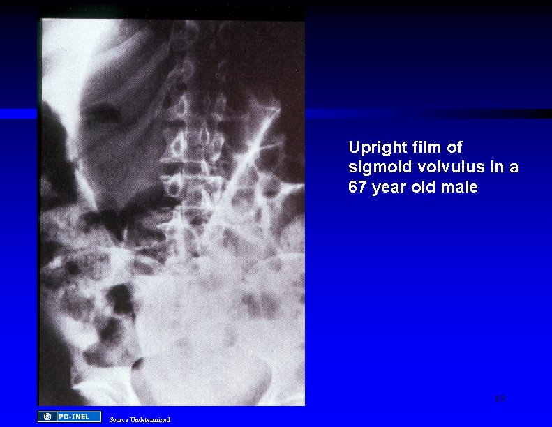 Upright film of sigmoid volvulus in a 67 year old male 69 Source Undetermined