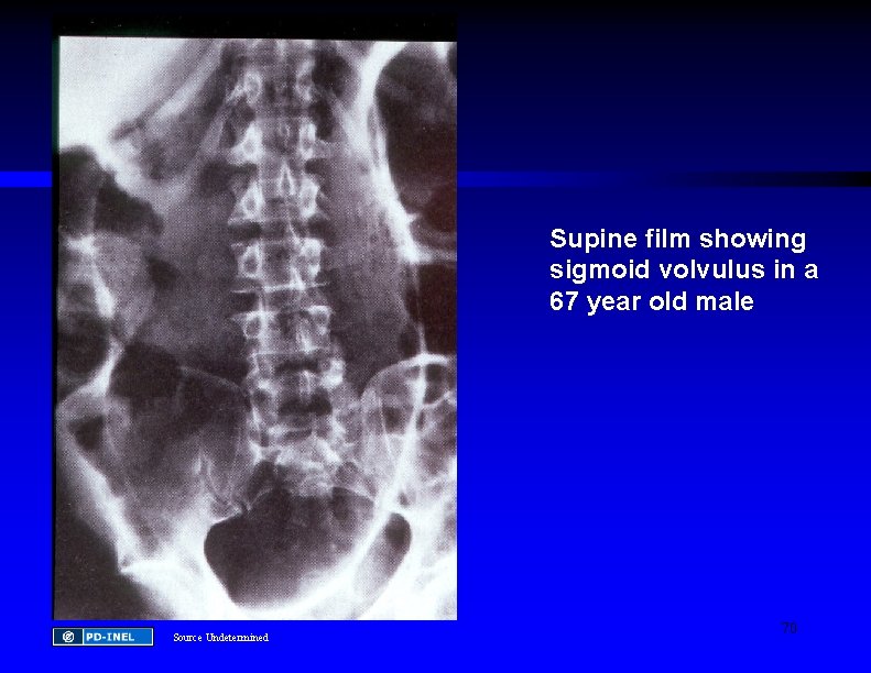 Supine film showing sigmoid volvulus in a 67 year old male Source Undetermined 70