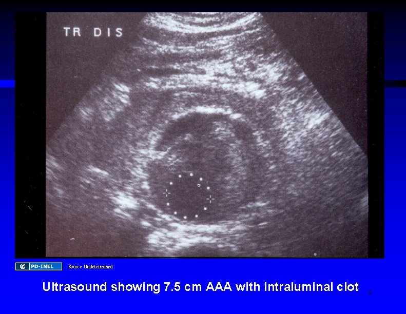 Source Undetermined Ultrasound showing 7. 5 cm AAA with intraluminal clot 9 