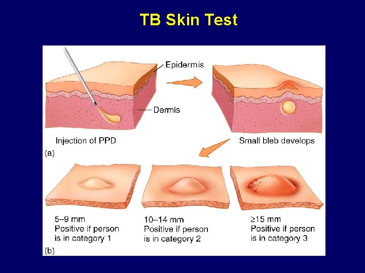 TB Skin Test 
