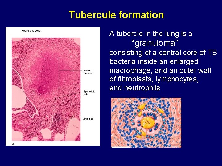 Tubercule formation A tubercle in the lung is a “granuloma” consisting of a central