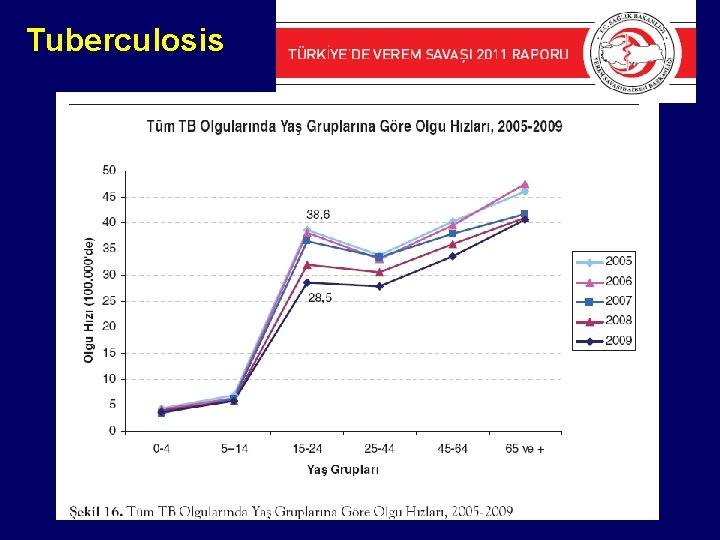 Tuberculosis 