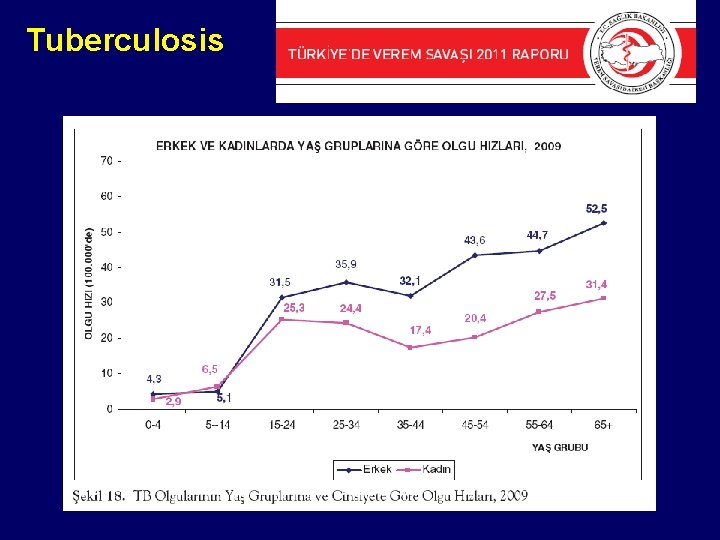 Tuberculosis 
