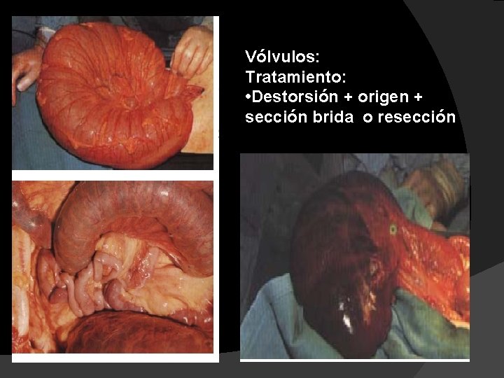 Vólvulos: Tratamiento: • Destorsión + origen + sección brida o resección 