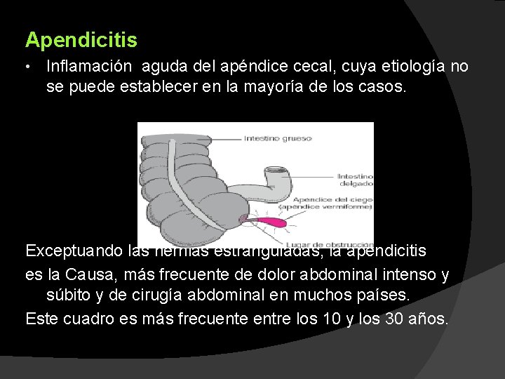 Apendicitis • Inflamación aguda del apéndice cecal, cuya etiología no se puede establecer en