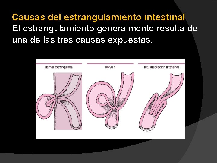 Causas del estrangulamiento intestinal El estrangulamiento generalmente resulta de una de las tres causas