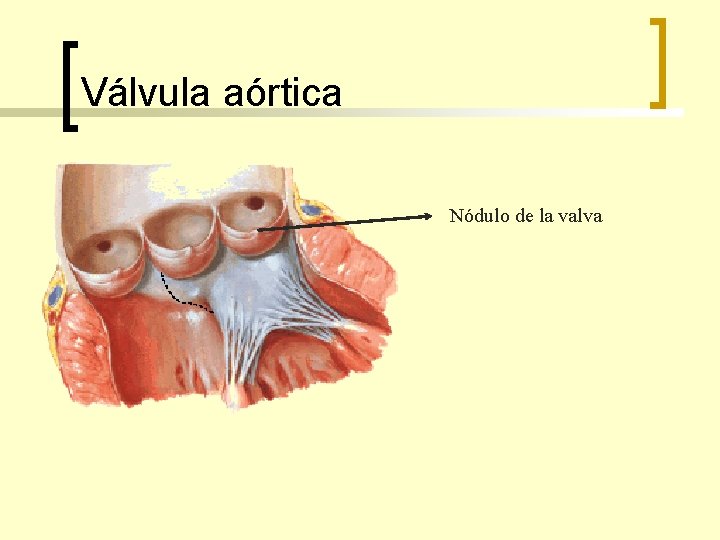 Válvula aórtica Nódulo de la valva 