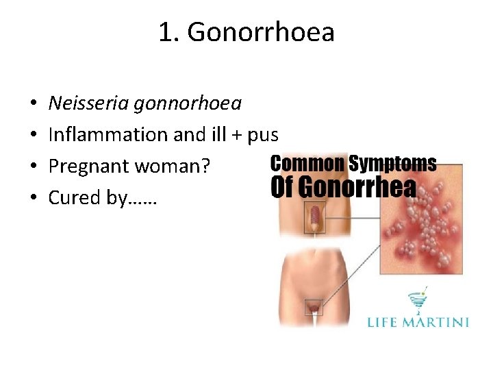 1. Gonorrhoea • • Neisseria gonnorhoea Inflammation and ill + pus Pregnant woman? Cured