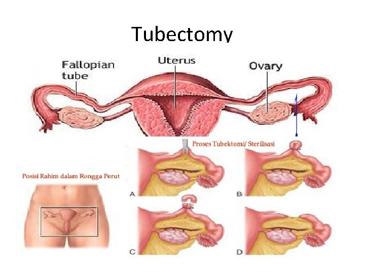 Tubectomy 