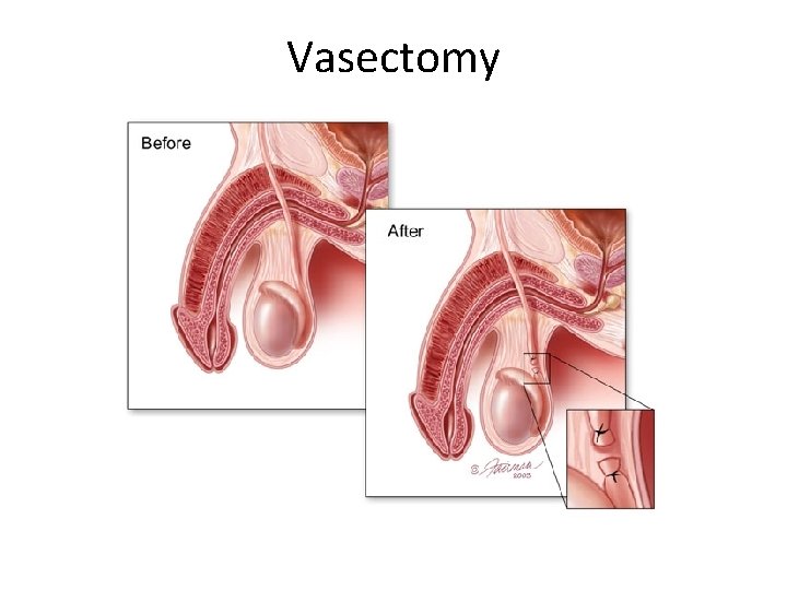 Vasectomy 