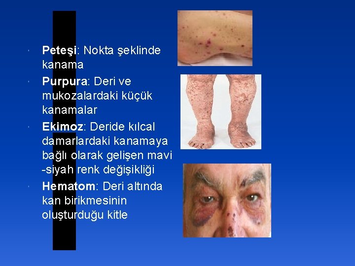 Peteşi: Nokta şeklinde kanama Purpura: Deri ve mukozalardaki küçük kanamalar Ekimoz: Deride kılcal damarlardaki