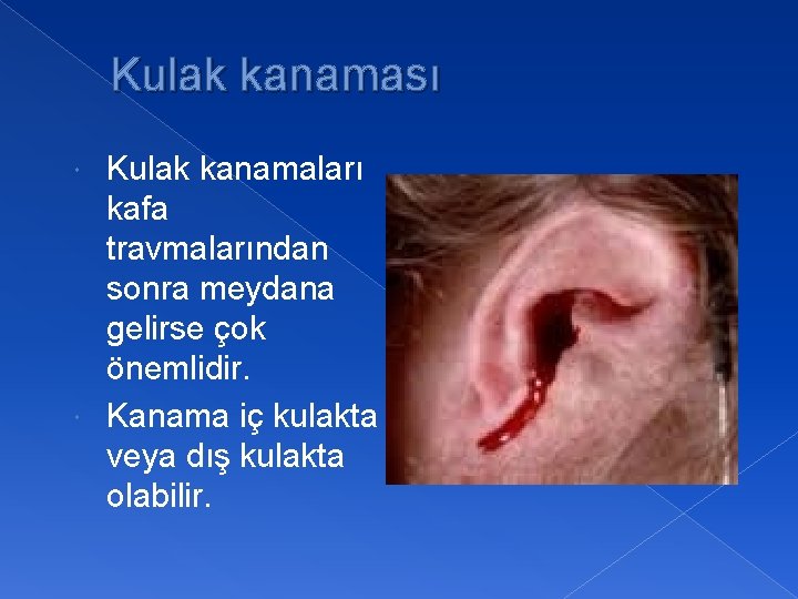 Kulak kanaması Kulak kanamaları kafa travmalarından sonra meydana gelirse çok önemlidir. Kanama iç kulakta
