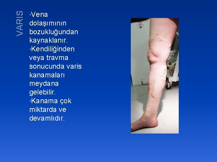 VARIS • Vena dolaşımının bozukluğundan kaynaklanır. • Kendiliğinden veya travma sonucunda varis kanamaları meydana