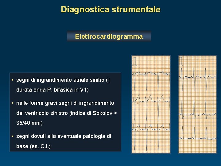 Diagnostica strumentale Elettrocardiogramma • segni di ingrandimento atriale sinitro (↑ durata onda P, bifasica