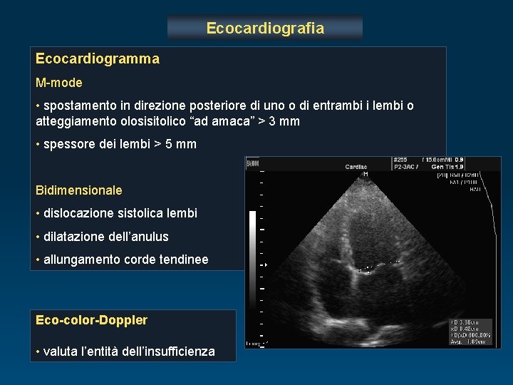 Ecocardiografia Ecocardiogramma M-mode • spostamento in direzione posteriore di uno o di entrambi i