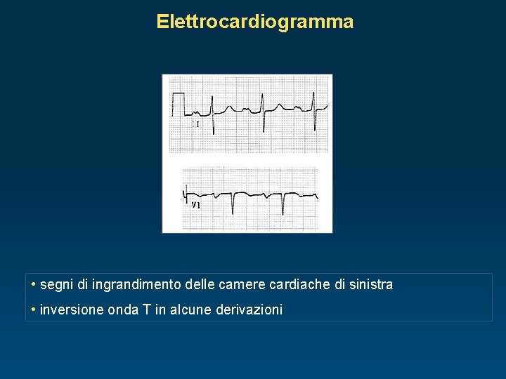 Elettrocardiogramma • segni di ingrandimento delle camere cardiache di sinistra • inversione onda T