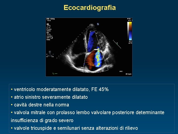 Ecocardiografia • ventricolo moderatamente dilatato, FE 45% • atrio sinistro severamente dilatato • cavità