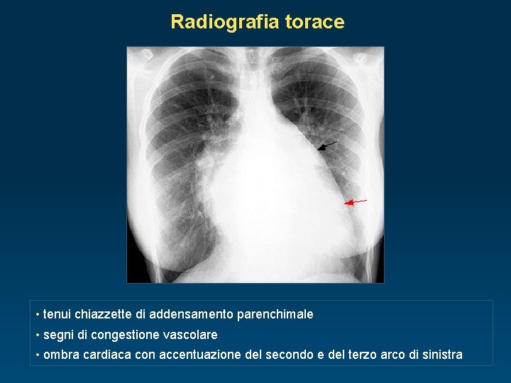 Radiografia torace • tenui chiazzette di addensamento parenchimale • segni di congestione vascolare •