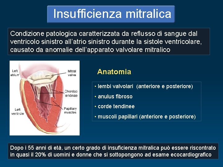 Insufficienza mitralica Condizione patologica caratterizzata da reflusso di sangue dal ventricolo sinistro all’atrio sinistro