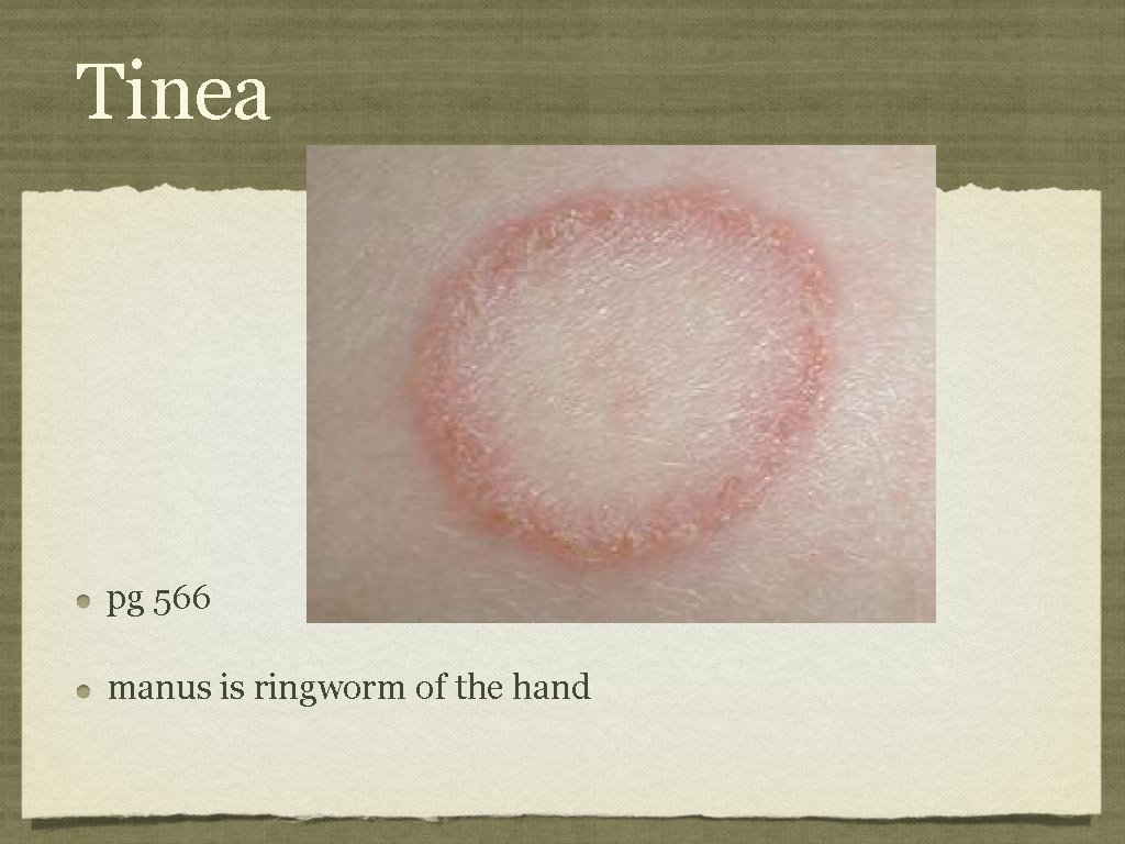 Tinea pg 566 manus is ringworm of the hand 