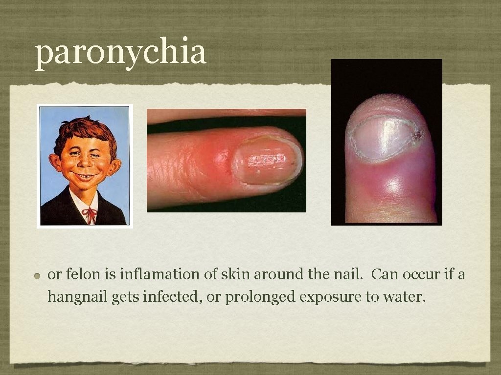 paronychia or felon is inflamation of skin around the nail. Can occur if a