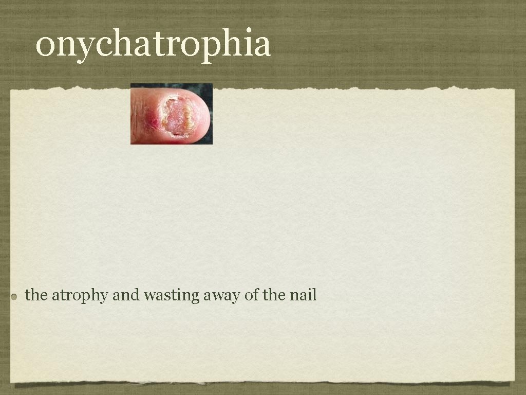 onychatrophia the atrophy and wasting away of the nail 