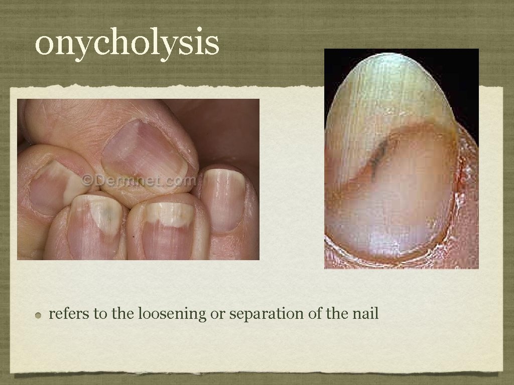 onycholysis refers to the loosening or separation of the nail 