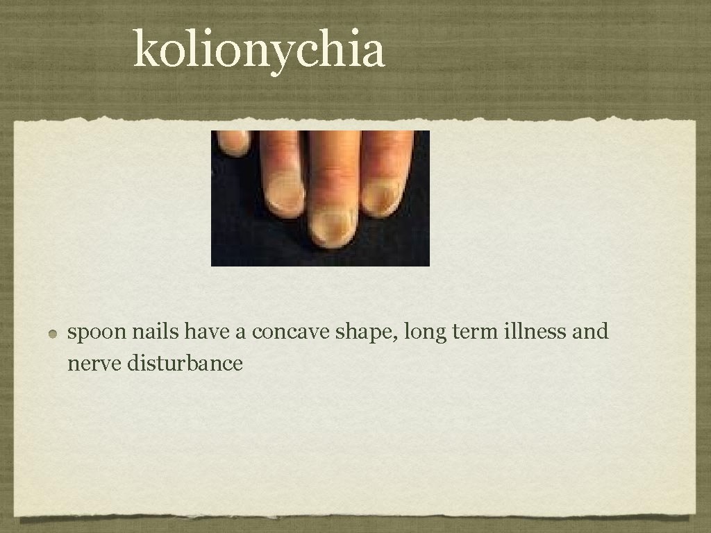 kolionychia spoon nails have a concave shape, long term illness and nerve disturbance 