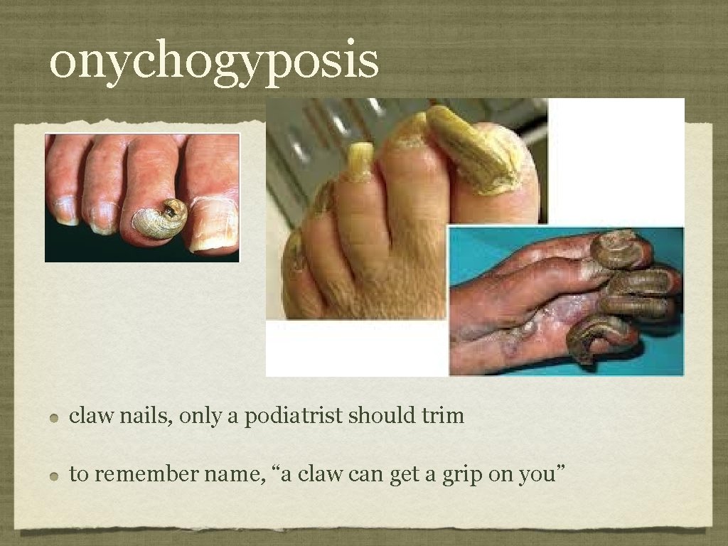 onychogyposis claw nails, only a podiatrist should trim to remember name, “a claw can