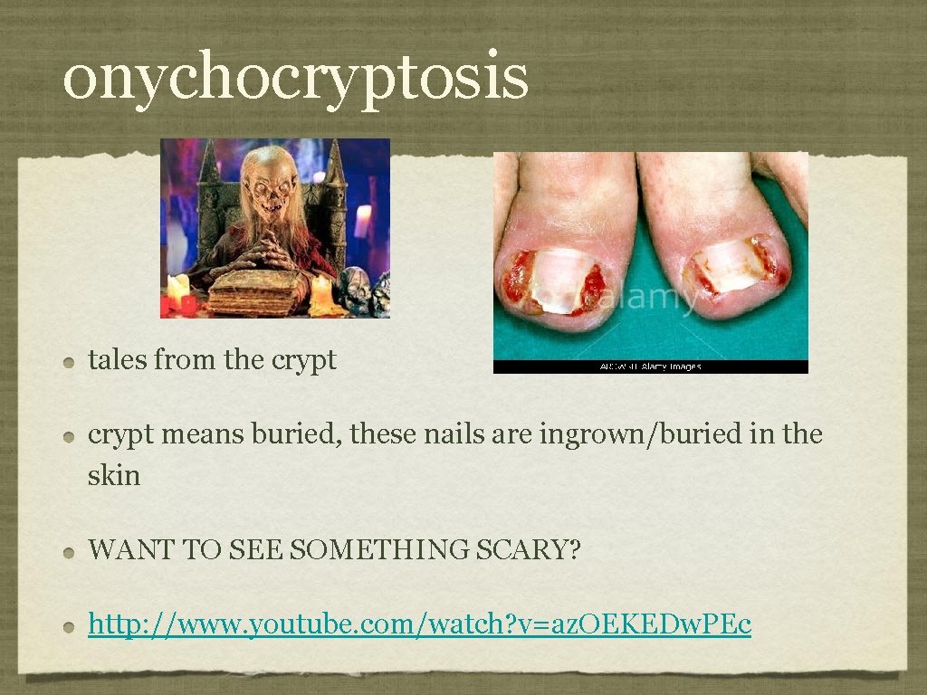 onychocryptosis tales from the crypt means buried, these nails are ingrown/buried in the skin