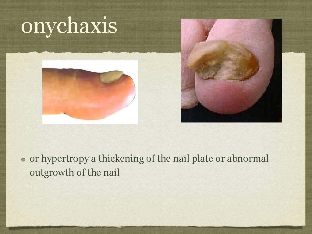 onychaxis or hypertropy a thickening of the nail plate or abnormal outgrowth of the