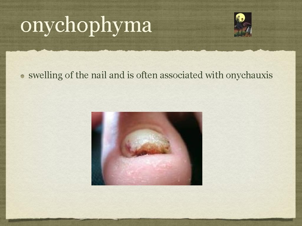 onychophyma swelling of the nail and is often associated with onychauxis 
