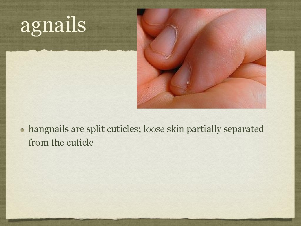 agnails hangnails are split cuticles; loose skin partially separated from the cuticle 
