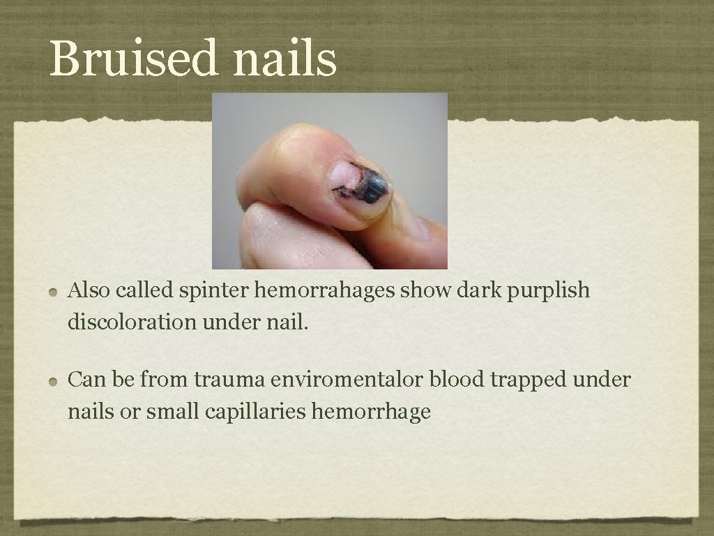 Bruised nails Also called spinter hemorrahages show dark purplish discoloration under nail. Can be