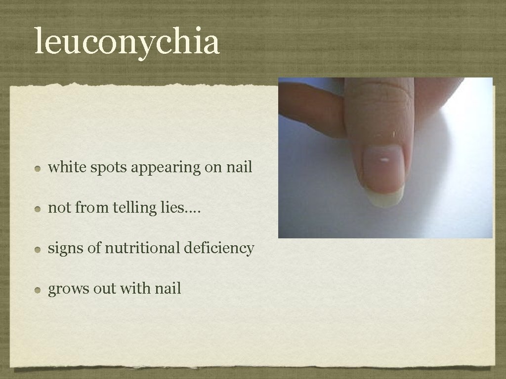 leuconychia white spots appearing on nail not from telling lies. . signs of nutritional
