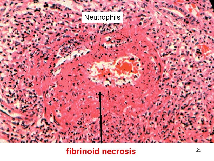 Neutrophils fibrinoid necrosis 26 