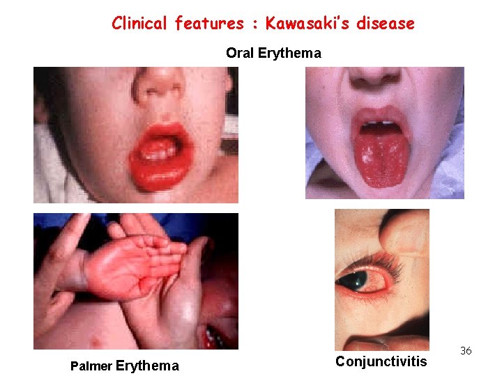 Clinical features : Kawasaki’s disease Oral Erythema Palmer Erythema Conjunctivitis 36 