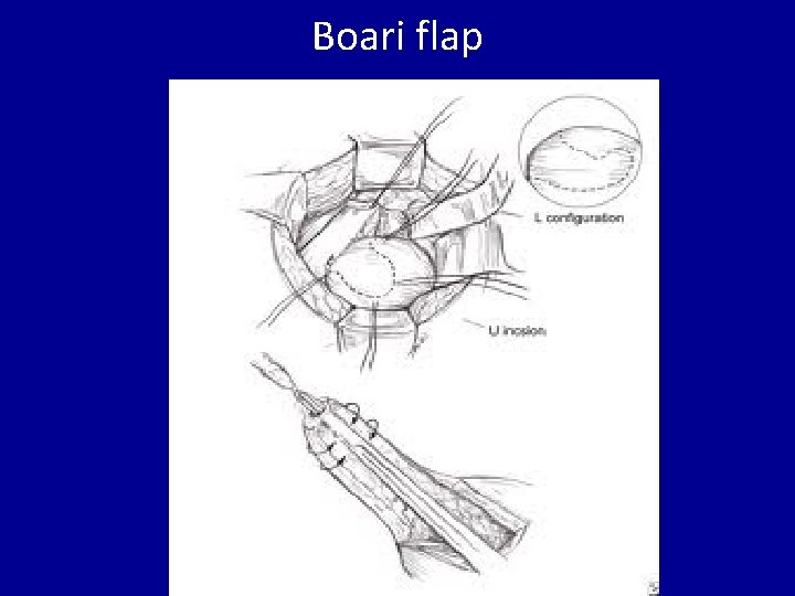 Boari flap 