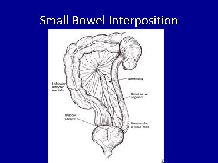 Small Bowel Interposition 