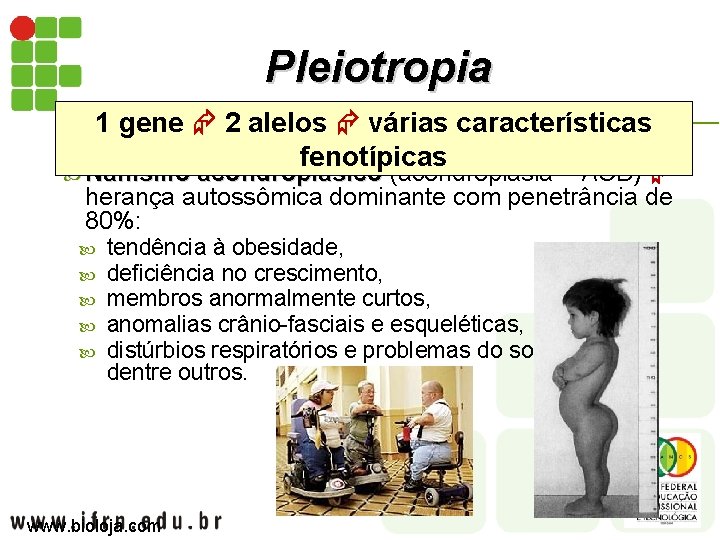 Pleiotropia 1 gene 2 alelos várias características fenotípicas Nanismo acondroplásico (acondroplasia – ACD) Nanismo