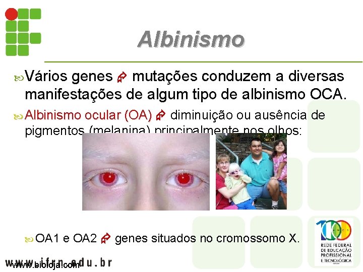 Albinismo Vários genes mutações conduzem a diversas manifestações de algum tipo de albinismo OCA.