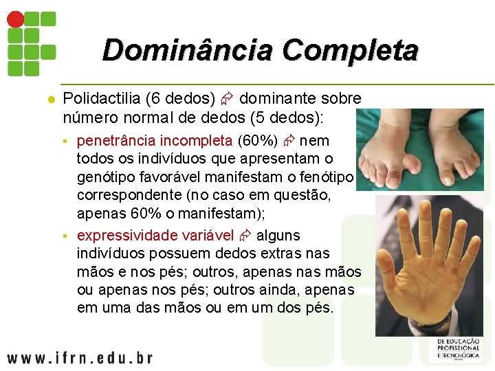 Dominância Completa l Polidactilia (6 dedos) dominante sobre número normal de dedos (5 dedos):