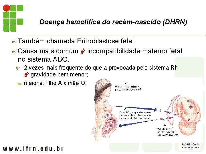 Doença hemolítica do recém-nascido (DHRN) Também chamada Eritroblastose fetal. Causa mais comum incompatibilidade materno